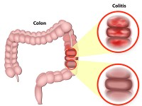 炎症性腸疾患の治療 ：神戸大が発見した「クローン病」や「潰瘍性大腸炎」の治療につながる物質とは