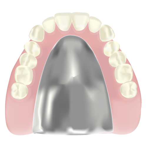 【イラストで紹介】金属を使った入れ歯